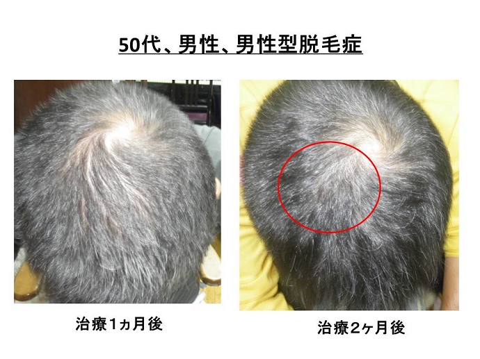 円形脱毛症　病院